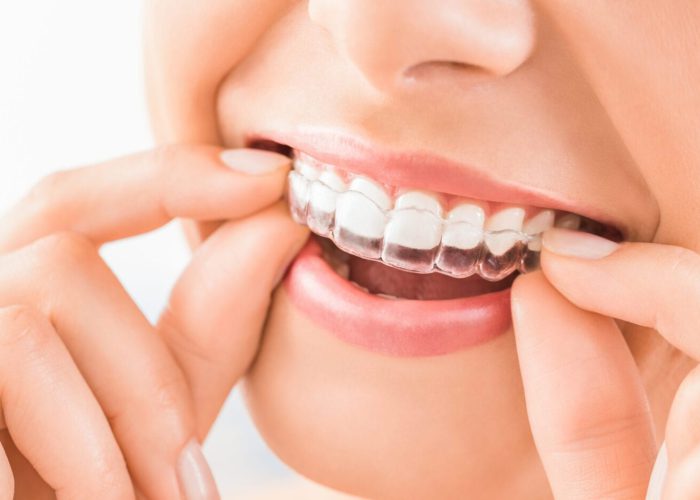 Overcoming Teeth Grinding